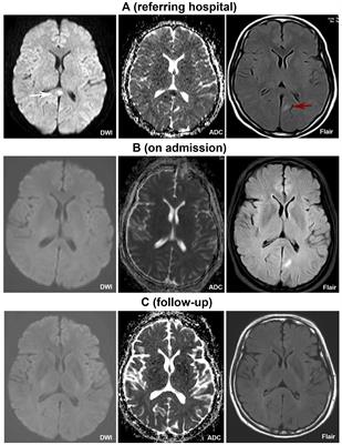 Case report: Rare Guillain-Barré syndrome variants and mild encephalitis/encephalopathy with a reversible splenial lesion as the para-infectious manifestations of SARS-CoV-2 infection